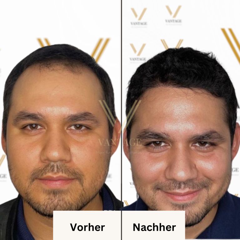 Fue Haartransplantation In Der T Rkei Kosten Im Jahr Vantage