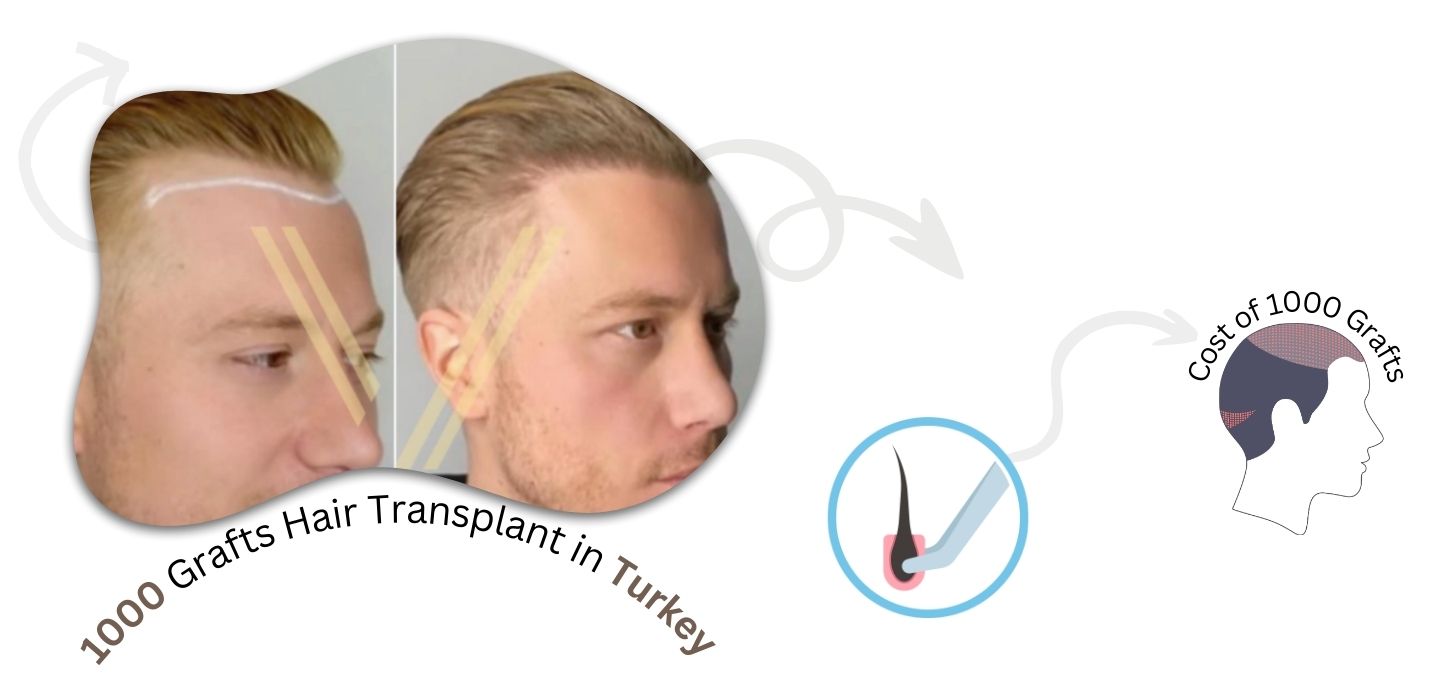 1000 Grafts Hair Transplant | Costs in 2024 | Vantage