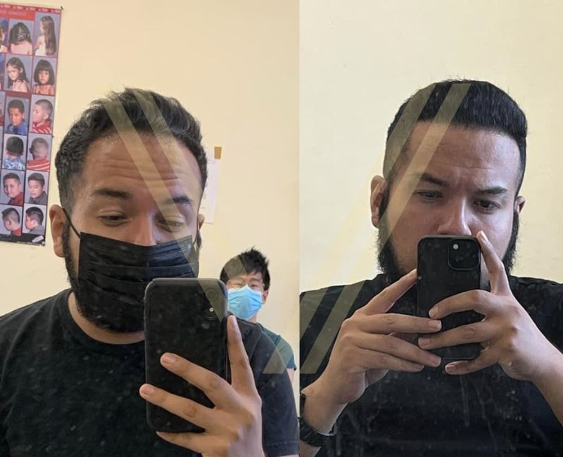 hairline lowering hair transplant before after