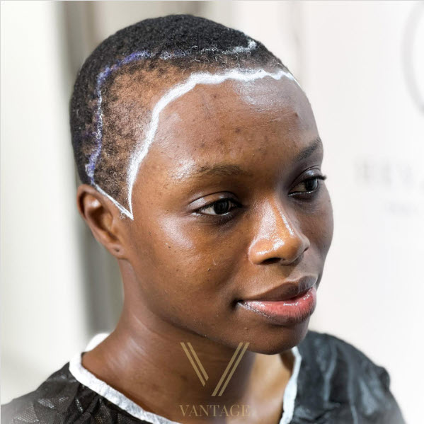 afro female hairline drawing before hair transplant in istanbul