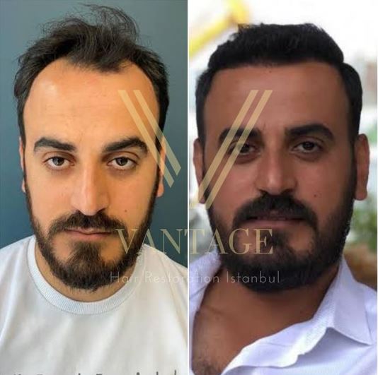 Haartransplantation vorher nachher in der Türkei