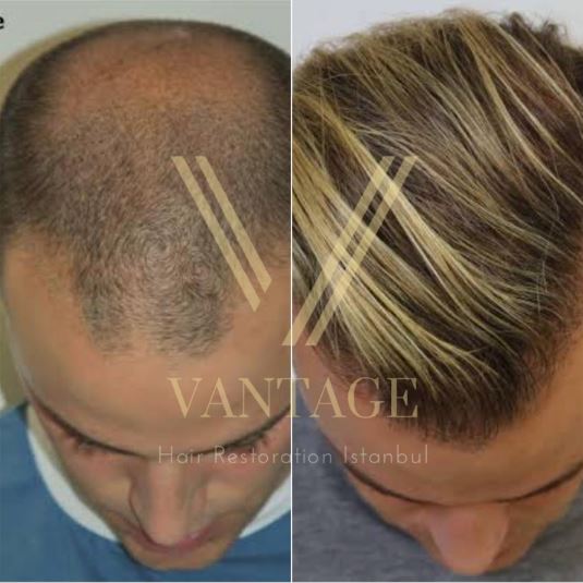 vor und nach einer Haartransplantation in Istanbul