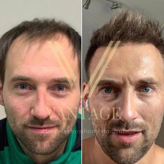 before after hair transplant in turkey hairline transformation