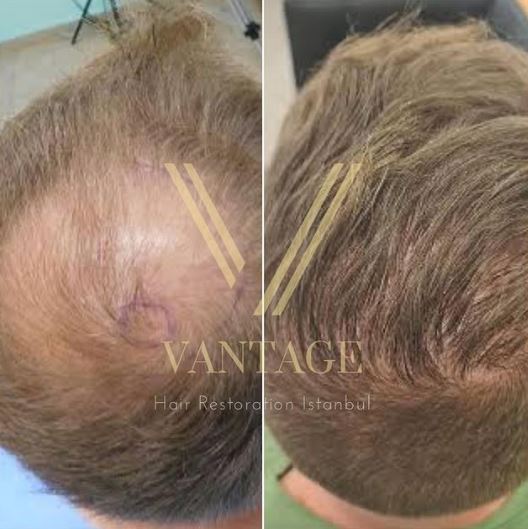 blonde hair transplant in turkey before and after