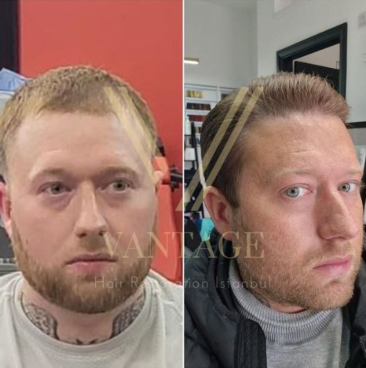 blonde hair transplant before after in turkey