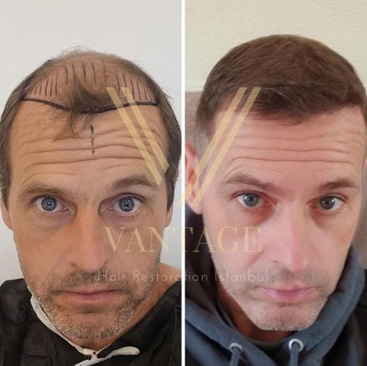 Haartransplantation Vorher Nachher Ergebnis in der Türkei