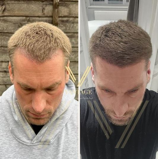 blonde hair transplant before after in turkey