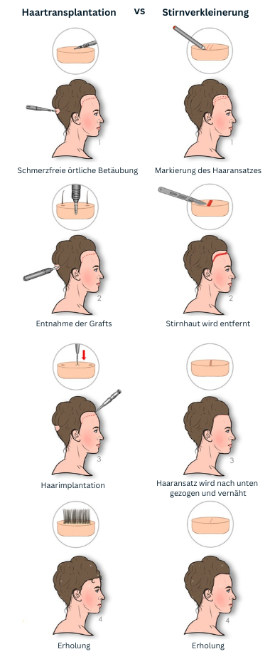 Haartransplantation vs. Stirnverkleinerung zur Senkung des Haaransatzes
