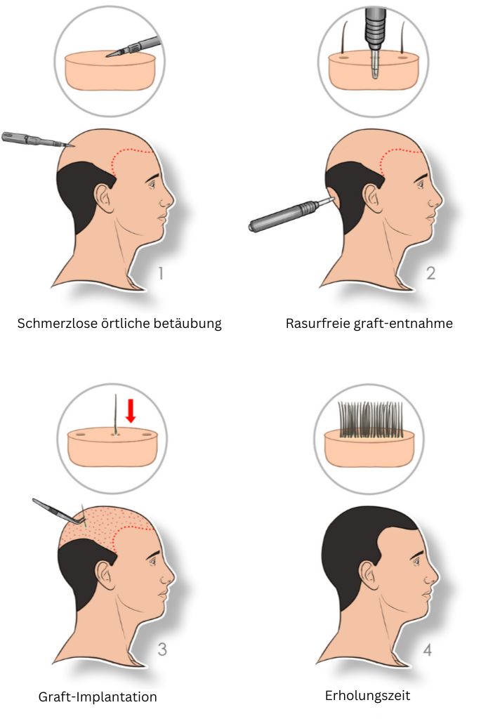 Schritte der FUE-Haartransplantation 
