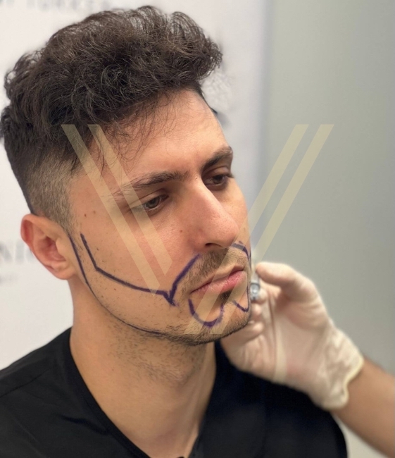 Schnurrbart- und Barttransplantation in Istanbul vor der Operation