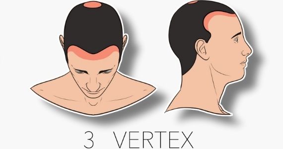 type 3 vertex norwood hair loss scale