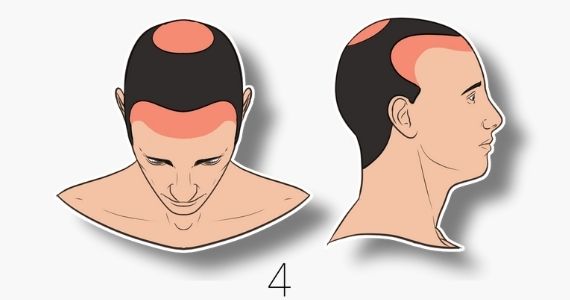 type 4 norwood hair loss scale
