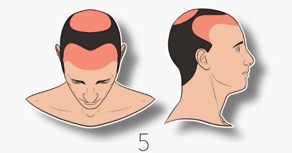 type 5 norwood hair loss scale