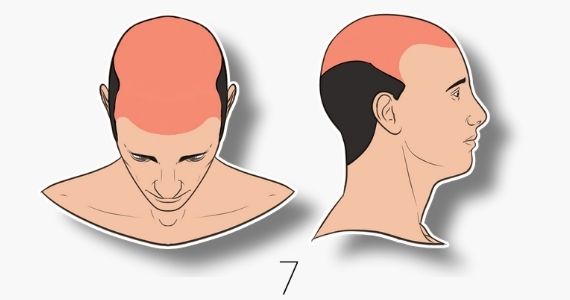 type 7 norwood hair loss scale