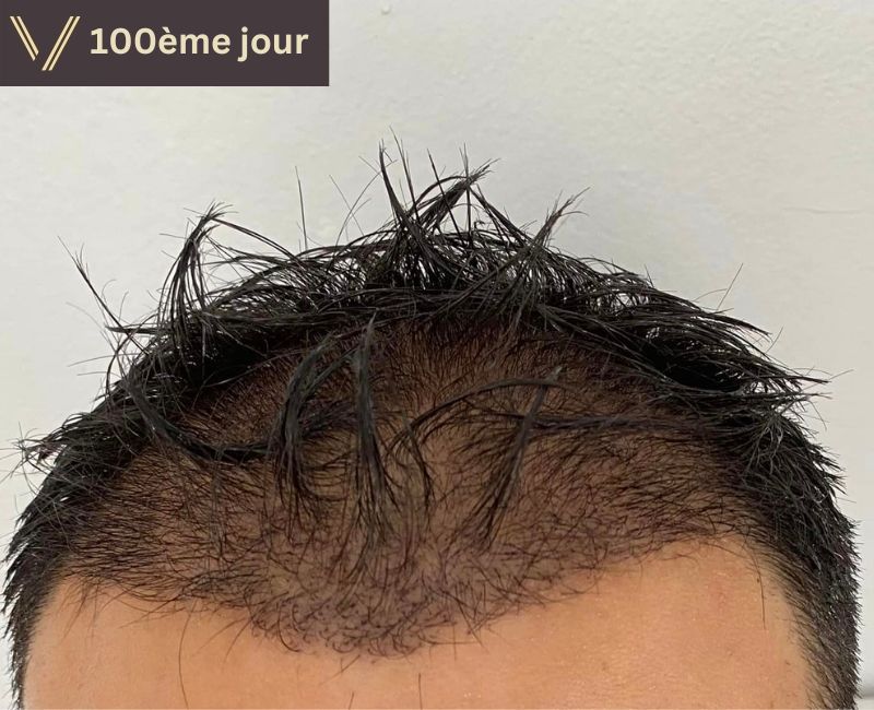 100 jours après la photo de récupération de la greffe de cheveux