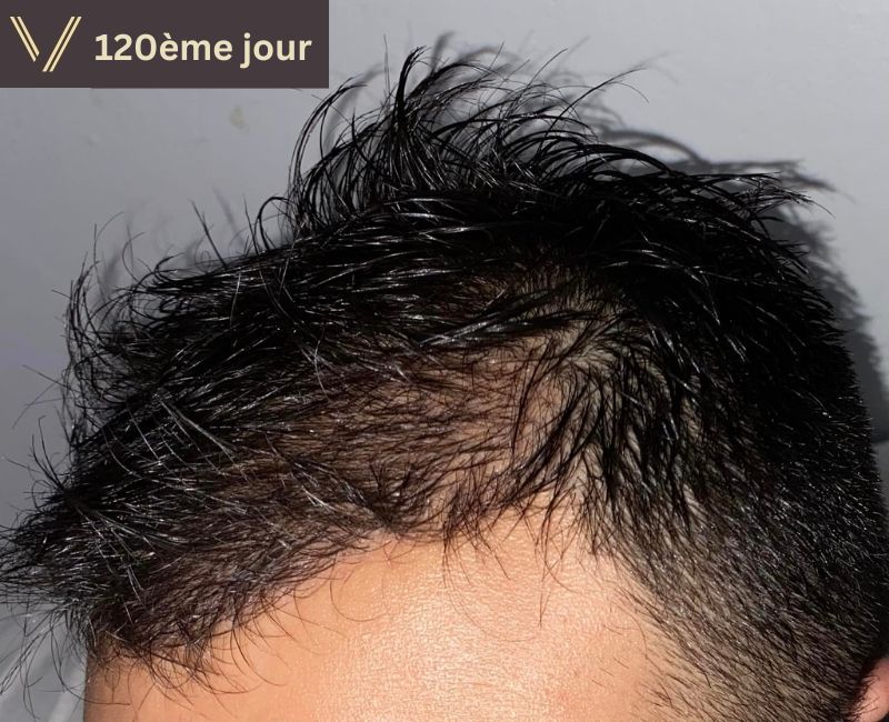 120 jours après la photo de récupération de la greffe de cheveux