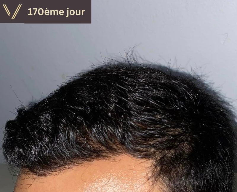 170 jours après la greffe de cheveux