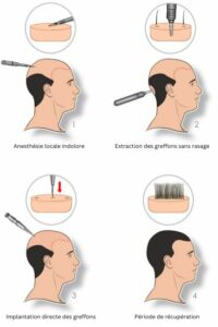 DHI greffe de cheveux procédure etapes