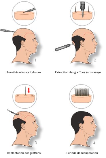 FUE greffe de cheveux procédure etapes