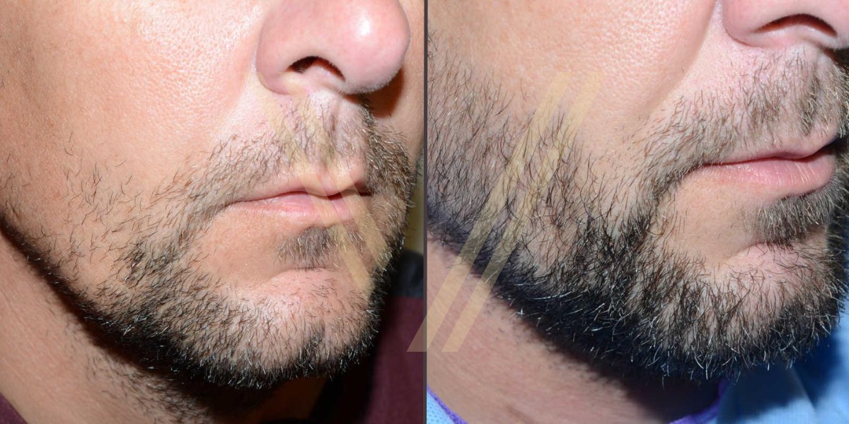 Implant de barbe en Turquie avant après