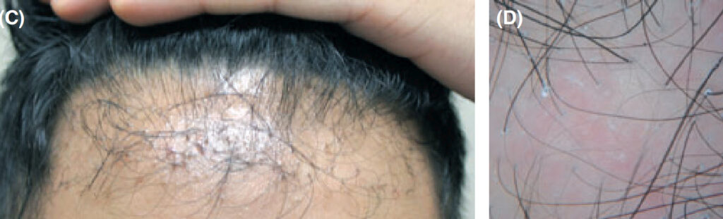 Lichen planopilaris rejet de greffe apres greffe de ligne de cheveux