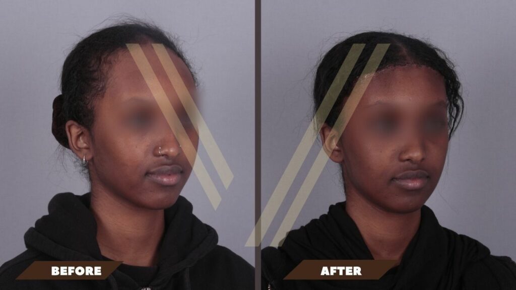 abaissement de la racine des cheveux chirurgie de réduction du front femme avant et après