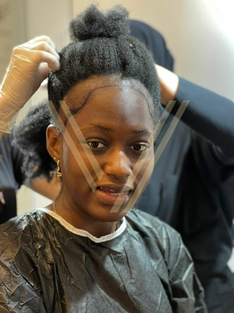afro greffe de cheveux femmes pre operation 