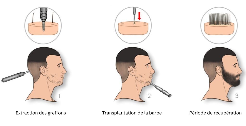 étapes de la greffe de barbe
