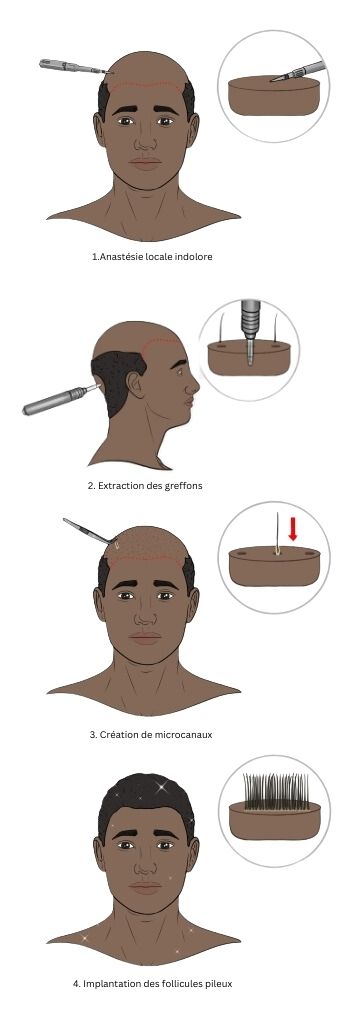 procédure de greffe de cheveux afro