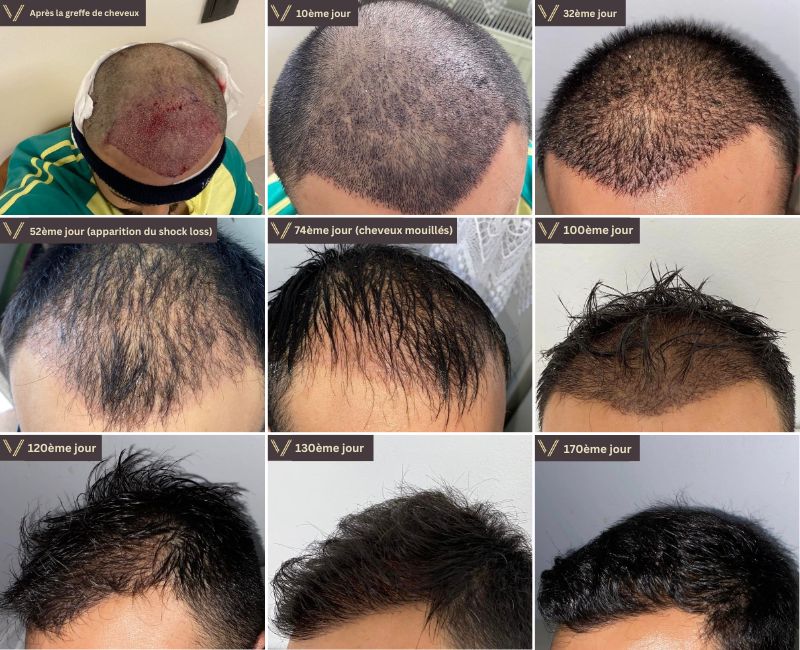 photos de collage de processus de récupération de croissance de greffe de cheveux