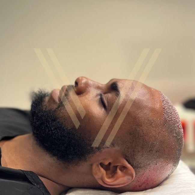 restauration de cheveux homme noir istanbul