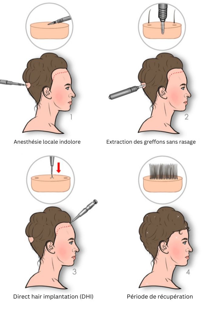 étapes de greffe de cheveux non rasés femme