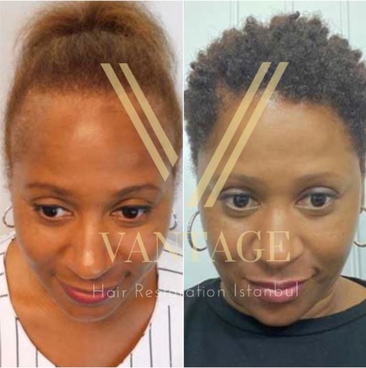 femme afro avant et après greffe de cheveux