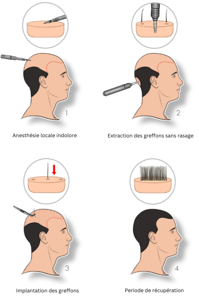 greffe-de-cheveux-fue-procedure-etapes