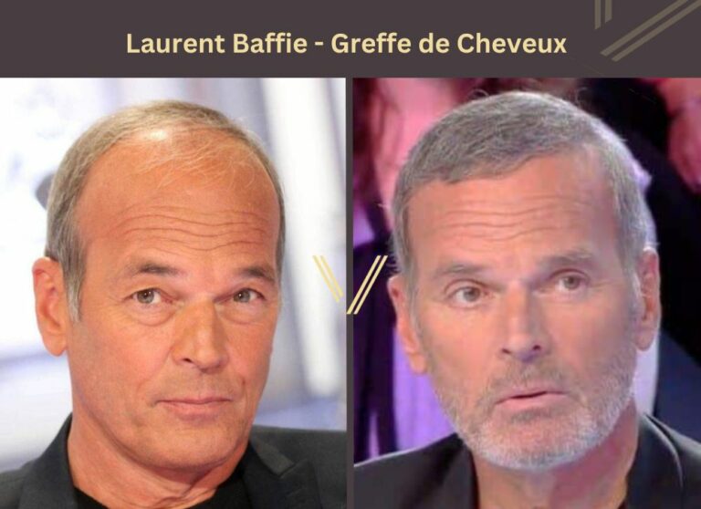 Greffe de Cheveux Chez les Stars | 35 Photos Avant et Après