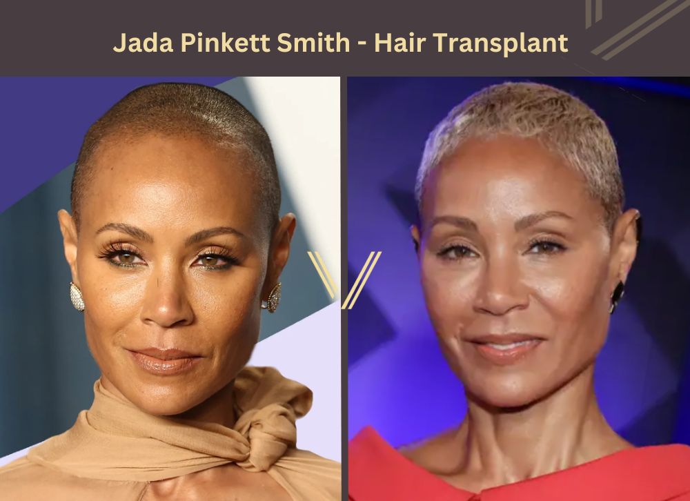 Greffe de cheveux de Jada Pinkett Smith 