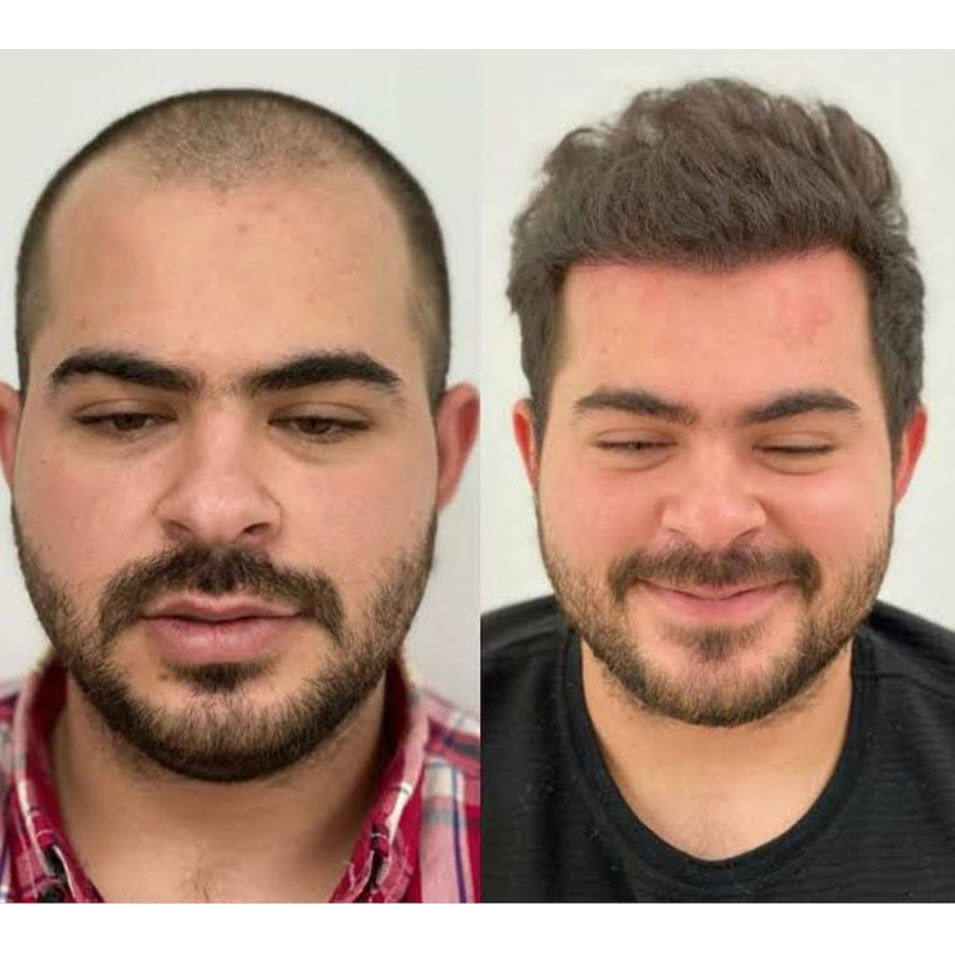 przeszczep włosów w Stambule przed po wyniku fue