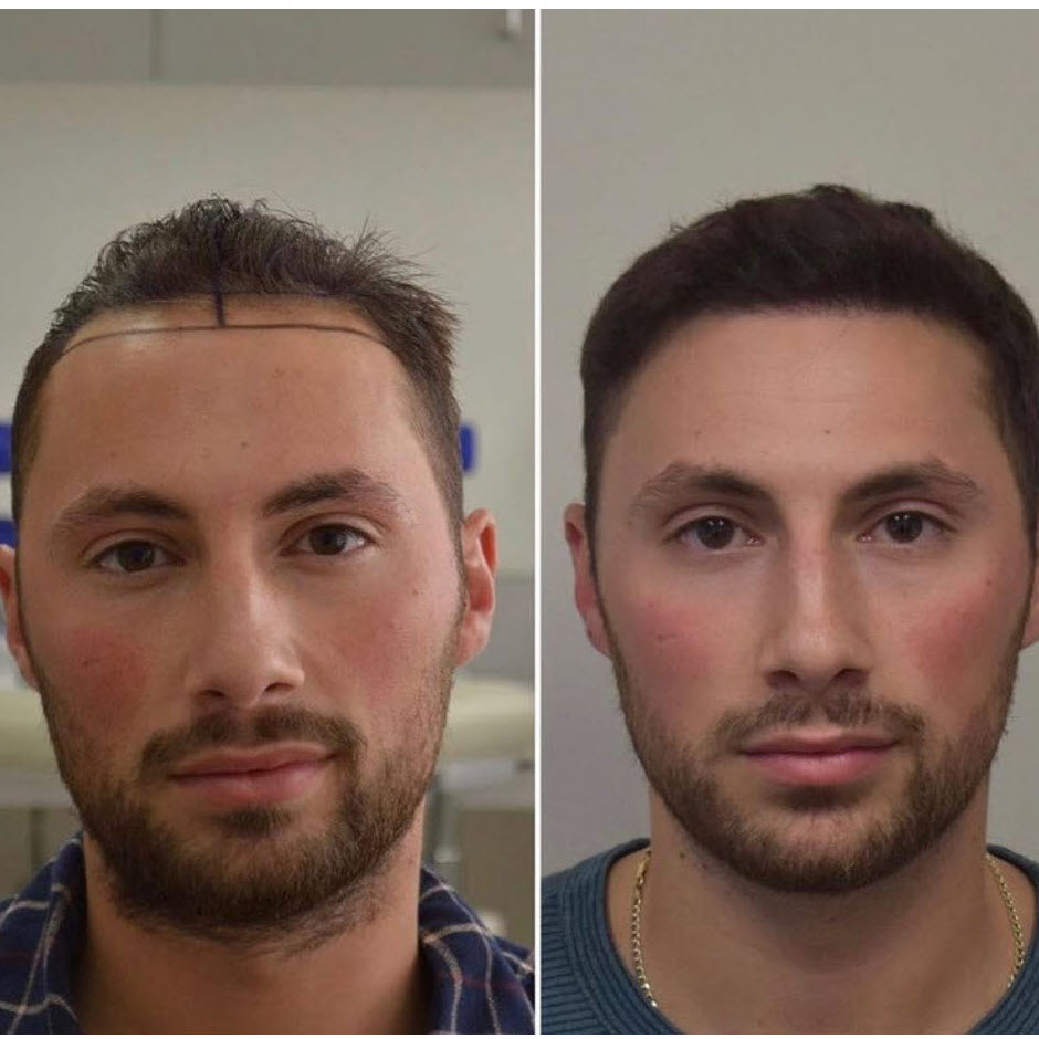 przeszczep włosów dhi w Stambule przed i po