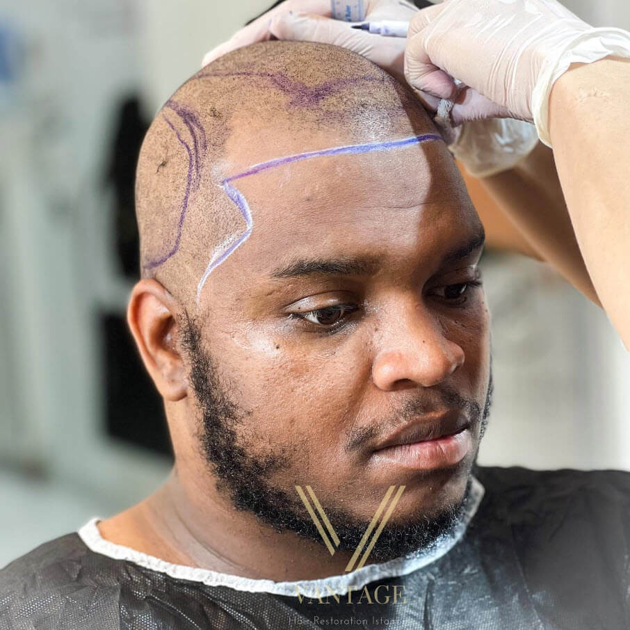 afro ethnic hair transplant in istanbul