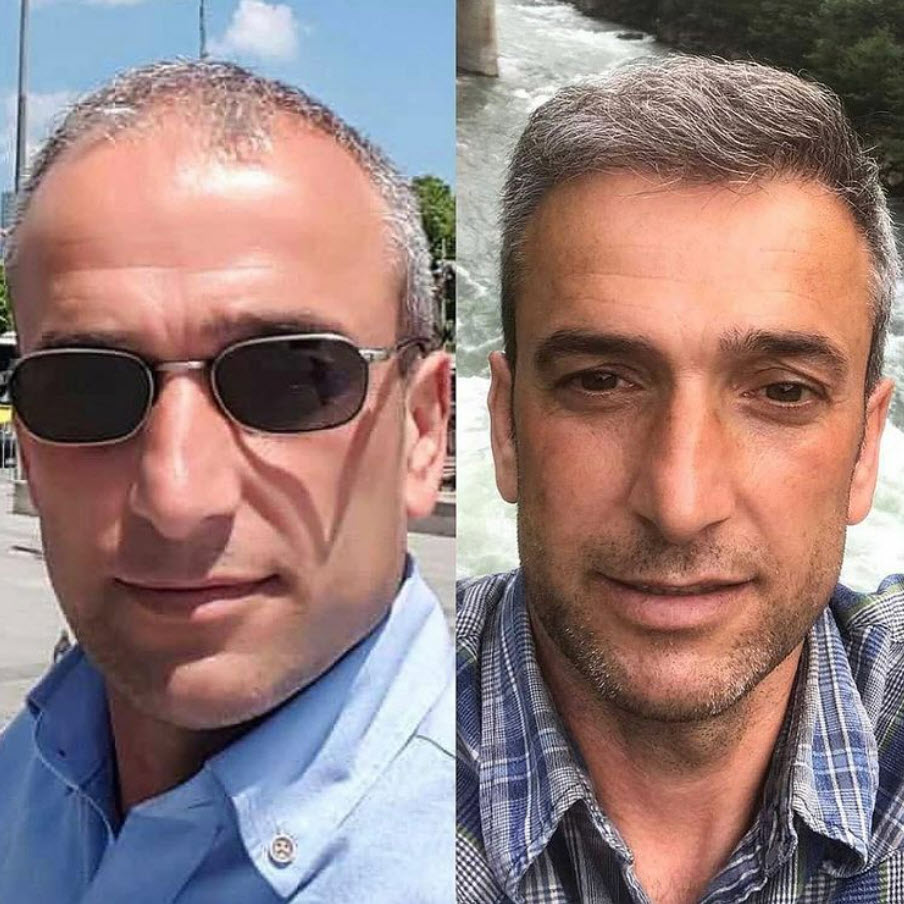 gray hair before and after hair transplant