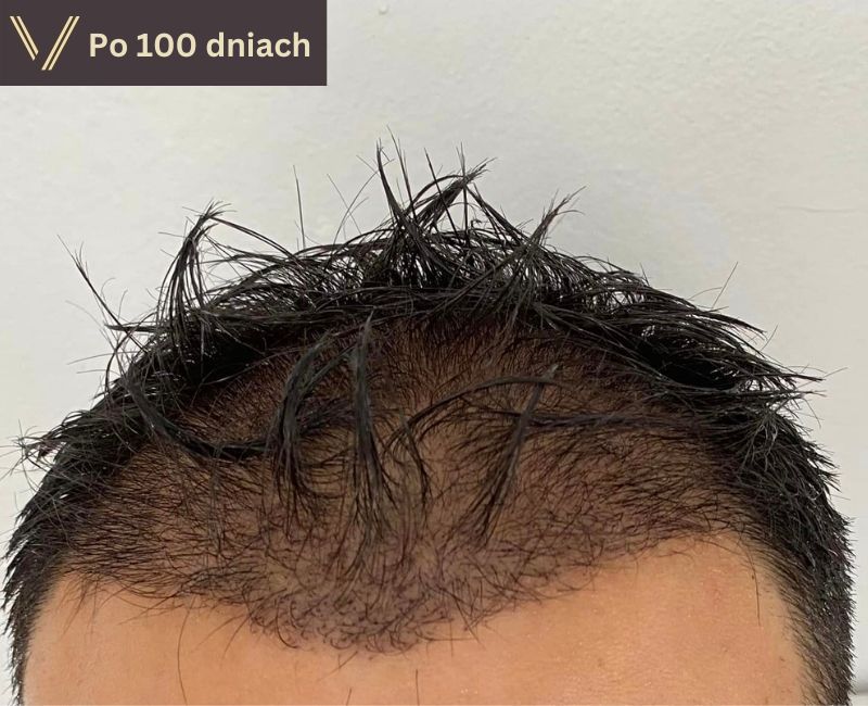 Zdjęcie 100 dni po rekonwalescencji po przeszczepie włosów