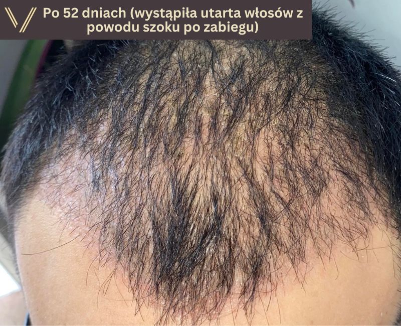 52 dni po przeszczepie włosów