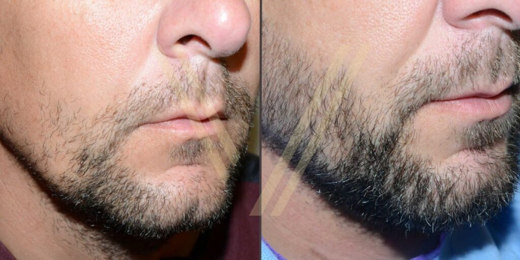 Przeszczep brody przed i po w Stambule w Turcji