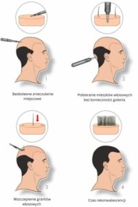 Etapy procedury przeszczepu włosów metodą FUE