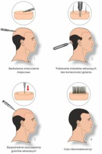 Etapy procedury przeszczepu włosów DHI