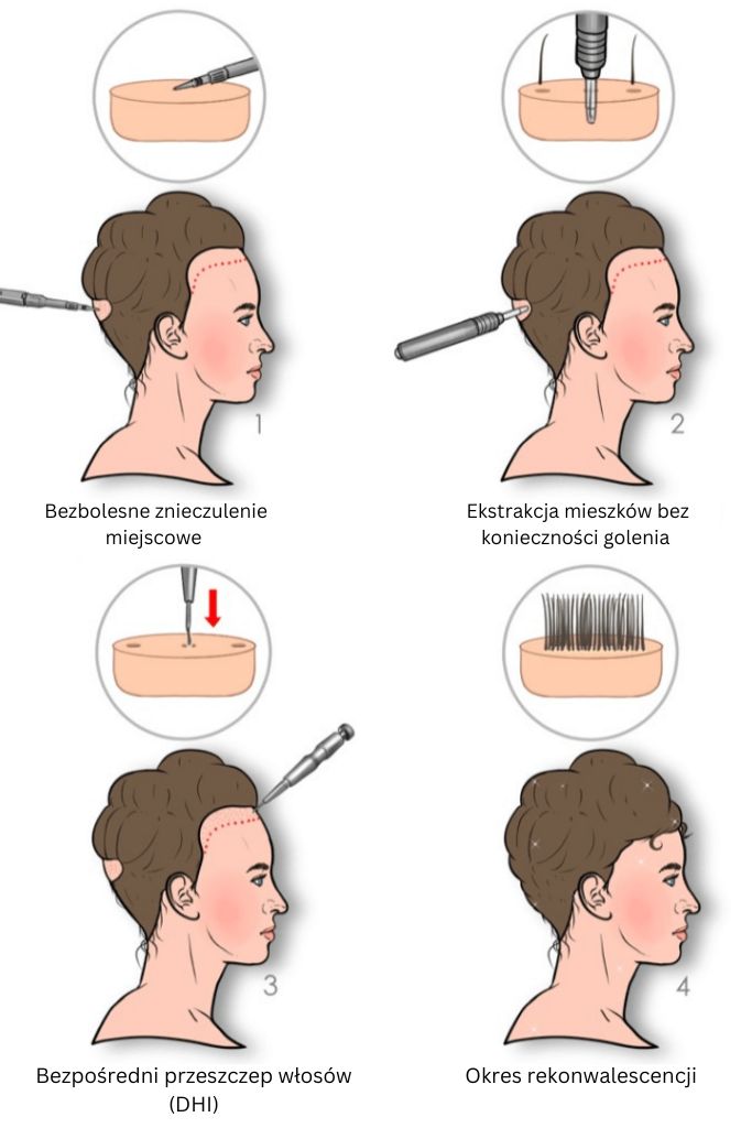 etapy procesu przeszczepu nieogolonych włosów kobiecych