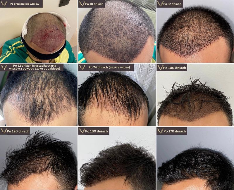 zdjęcie kolażu procesu odzyskiwania wzrostu przeszczepu włosów