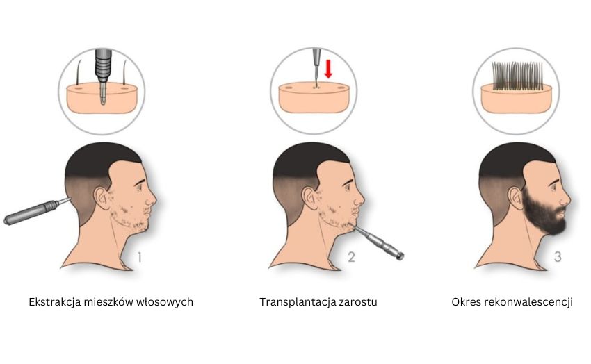 proces przeszczepu brody i wasow