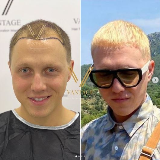 пересадка волос до и после светлых волос
