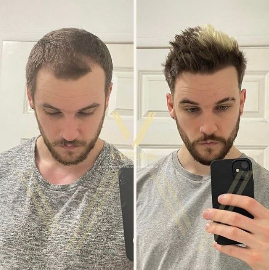 пересадка волос до и после